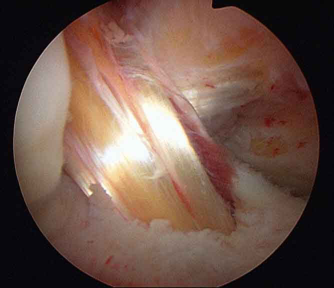 hamstring_acl