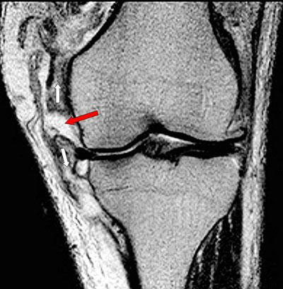 mri operatieve behandeling kruisband mri operatieve behandeling kruisband