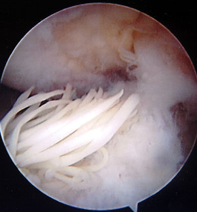 kruisband bloedvat xenograft kruisband bloedvat