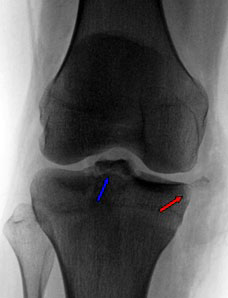 Diagnose voorste kruisband letsel Diagnose voorste kruisband letsel